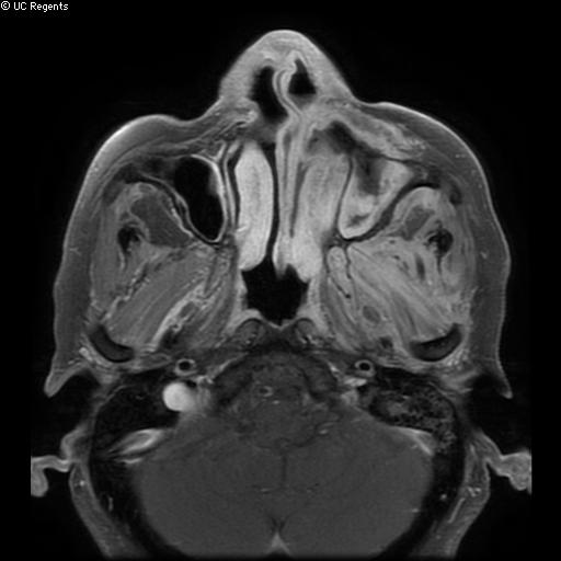Bisphosphonate-related osteonecrosis of the maxilla (Radiopaedia 51367-57101 Axial T1 C+ fat sat 25).jpg