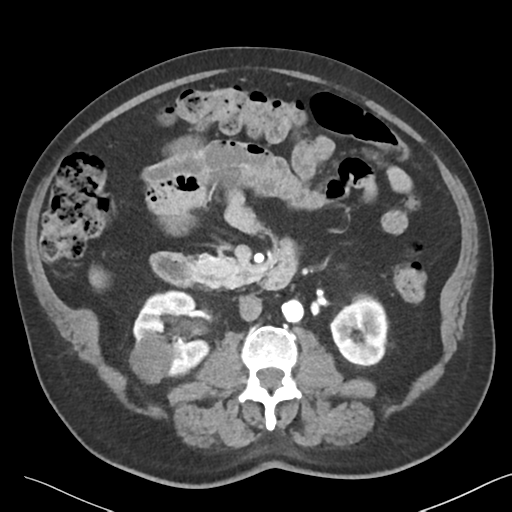 File:Bladder papillary urothelial carcinoma (Radiopaedia 48119-52951 A 22).png