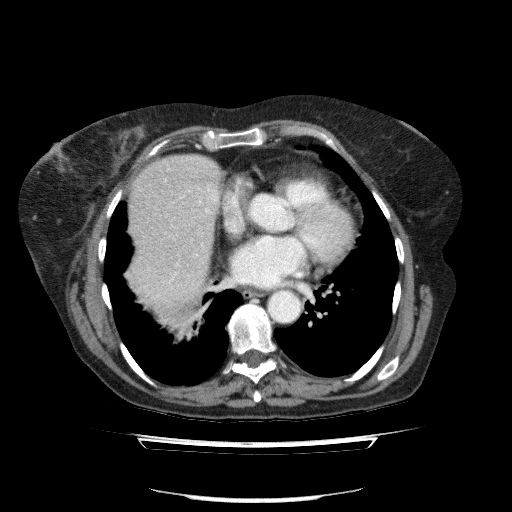 File:Bladder tumor detected on trauma CT (Radiopaedia 51809-57609 B 8).jpg