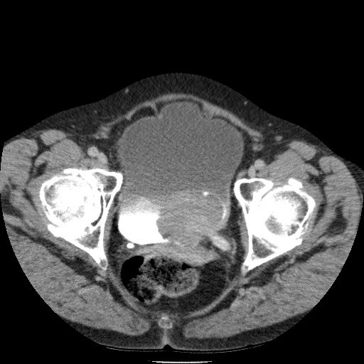 Bladder tumor detected on trauma CT (Radiopaedia 51809-57609 C 130).jpg