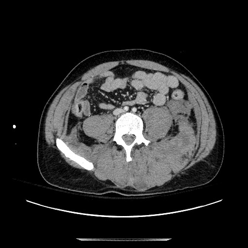 Blunt abdominal trauma with solid organ and musculoskelatal injury with active extravasation (Radiopaedia 68364-77895 A 97).jpg