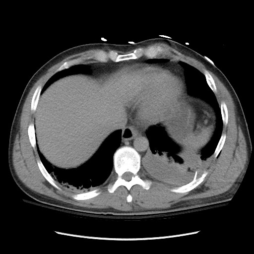 Blunt abdominal trauma with solid organ and musculoskelatal injury with active extravasation (Radiopaedia 68364-77895 Axial C+ delayed 17).jpg