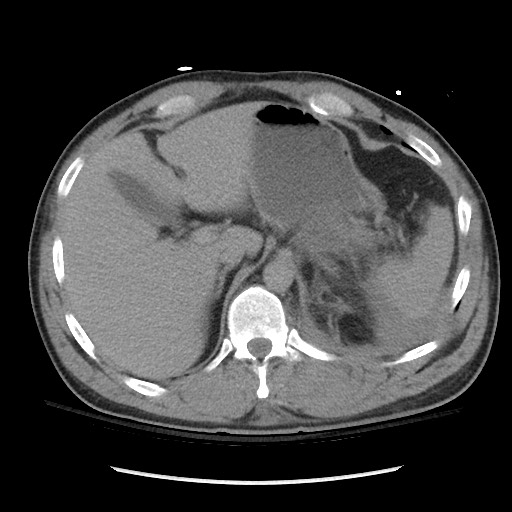 Blunt abdominal trauma with solid organ and musculoskelatal injury with active extravasation (Radiopaedia 68364-77895 Axial C+ delayed 32).jpg