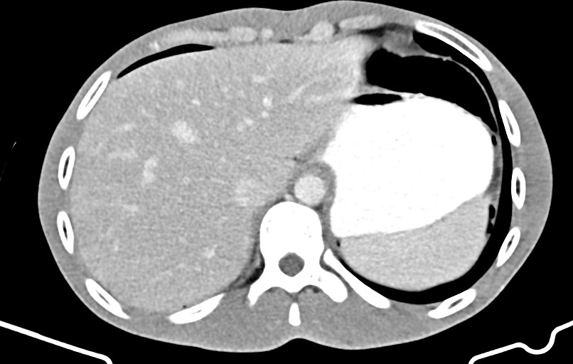 Blunt injury to the small bowel (Radiopaedia 74953-85987 A 13).jpg