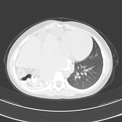 File:Bochdalek diaphragmatic hernia (Radiopaedia 38866-41059 Axial lung window 17).jpg