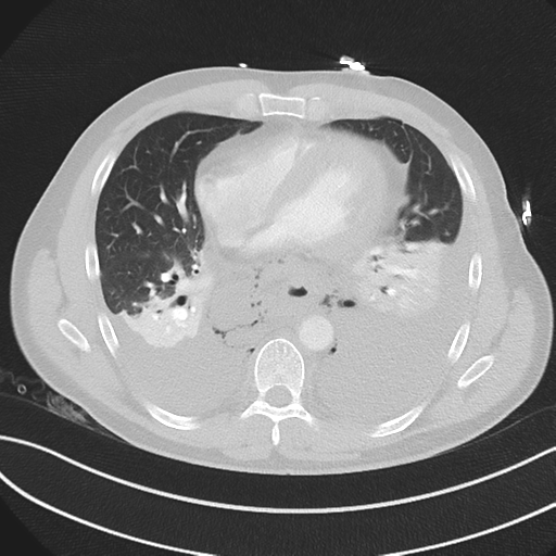 Boerhaave syndrome (Radiopaedia 39382-41660 Axial lung window 35).png