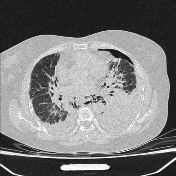 Boerhaave syndrome (Radiopaedia 45644-49799 Axial lung window 69).jpg