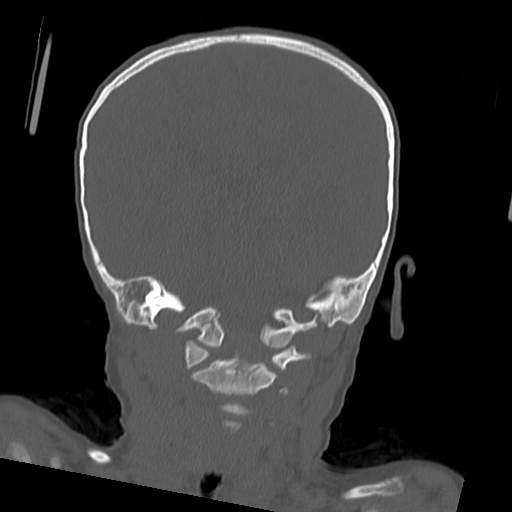 File:Bony atresia of the right external auditory canal (Radiopaedia 27916-28156 Coronal bone window 6).jpg