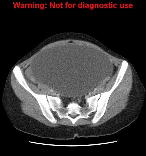 Borderline mucinous cystadenoma of ovary (Radiopaedia 25586-25767 A 79).jpg