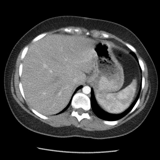 File:Borderline mucinous tumor (ovary) (Radiopaedia 78228-90808 A 40).jpg