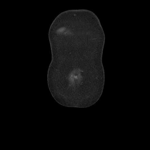 File:Borderline mucinous tumor (ovary) (Radiopaedia 78228-90808 C 5).jpg