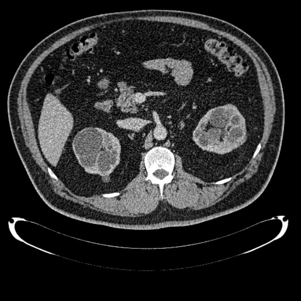 File:Bosniak renal cyst - type IV (Radiopaedia 24244-24518 C 124).jpg