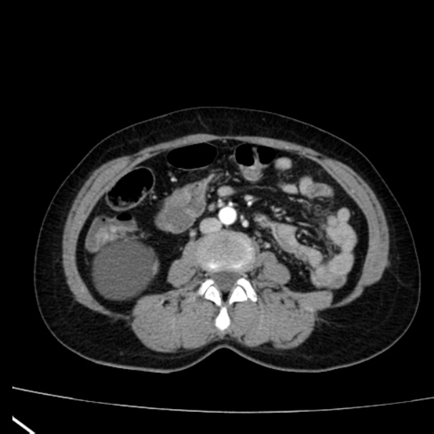 Bosniak renal cyst - type I (Radiopaedia 27479-27675 renal cortical phase 47).jpg