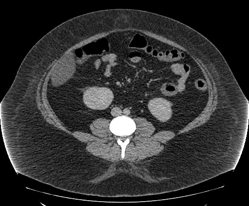 Bowel and splenic infarcts in acute lymphocytic leukemia (Radiopaedia 61055-68913 A 75).jpg
