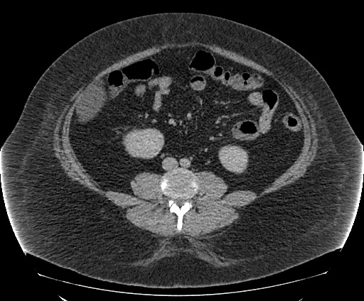 Bowel and splenic infarcts in acute lymphocytic leukemia (Radiopaedia 61055-68913 A 76).jpg