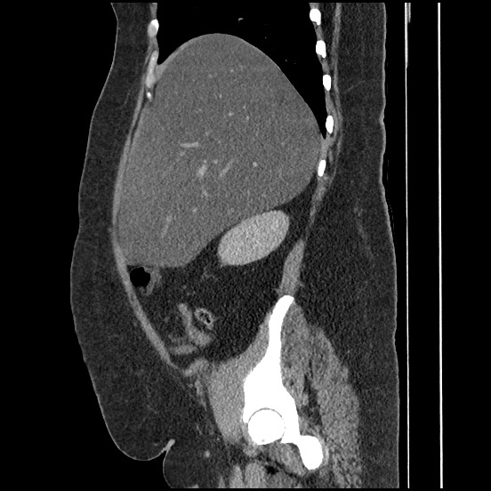 File:Bowel and splenic infarcts in acute lymphocytic leukemia (Radiopaedia 61055-68913 C 57).jpg