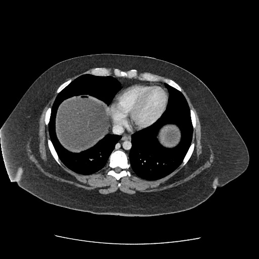 Bowel and splenic infarcts in acute lymphocytic leukemia (Radiopaedia 61055-68915 A 15).jpg