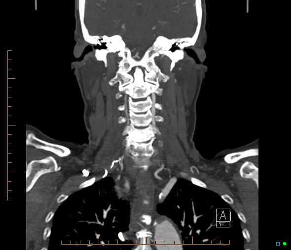 Brachiocephalic trunk stenosis (Radiopaedia 87242-103519 B 43).jpg