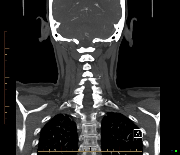 Brachiocephalic trunk stenosis (Radiopaedia 87242-103519 B 54).jpg