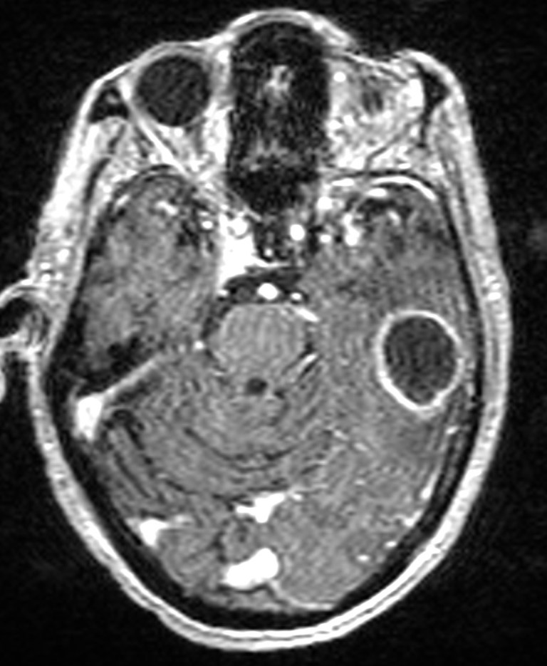 Brain abscess with dual rim sign (Radiopaedia 87566-103938 Axial T1 C+ 59).jpg