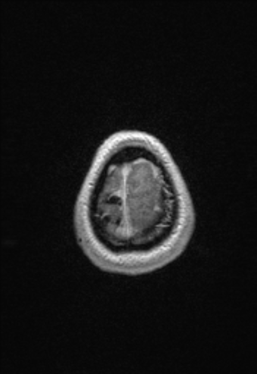 Brain abscess with ventriculitis (Radiopaedia 85703-101495 Axial T1 C+ 157).jpg