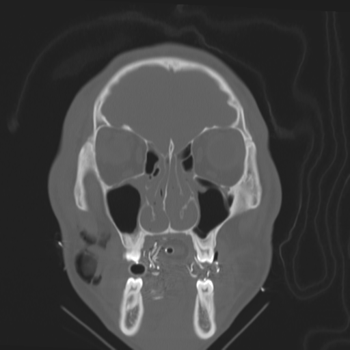 Brain contusions, internal carotid artery dissection and base of skull fracture (Radiopaedia 34089-35339 Coronal bone window 19).png
