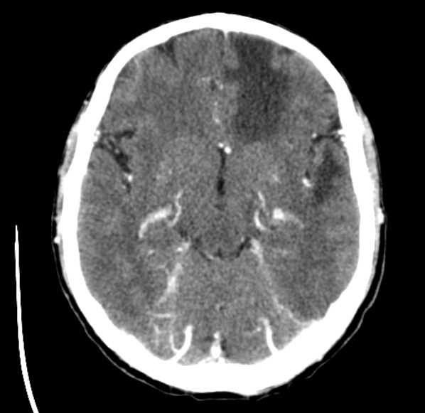 File:Brain metastases from lung cancer (Radiopaedia 24480-24781 Axial C+ delayed 23).jpg