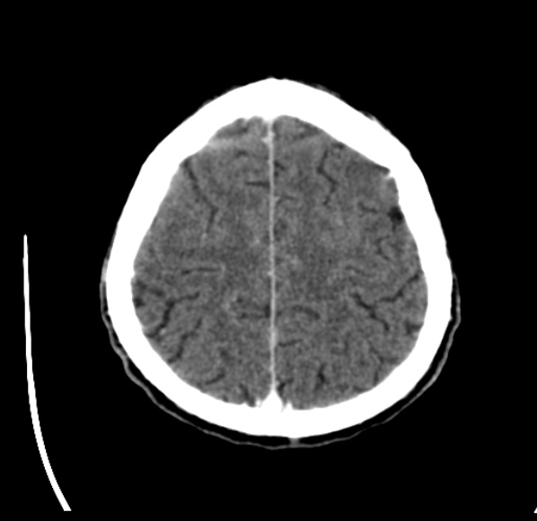 File:Brain metastases from lung cancer (Radiopaedia 24480-24781 Axial C+ delayed 51).jpg