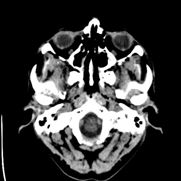 Brain metastases from lung cancer (Radiopaedia 24480-24781 Axial non-contrast 1).jpg