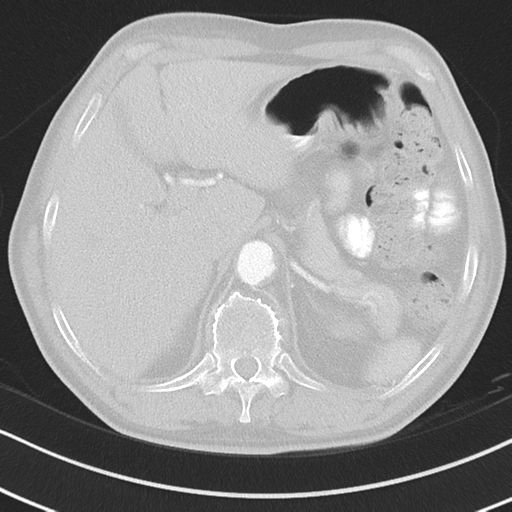 Brain metastasis (large cystic mass) (Radiopaedia 47497-52104 Axial lung window 46).png