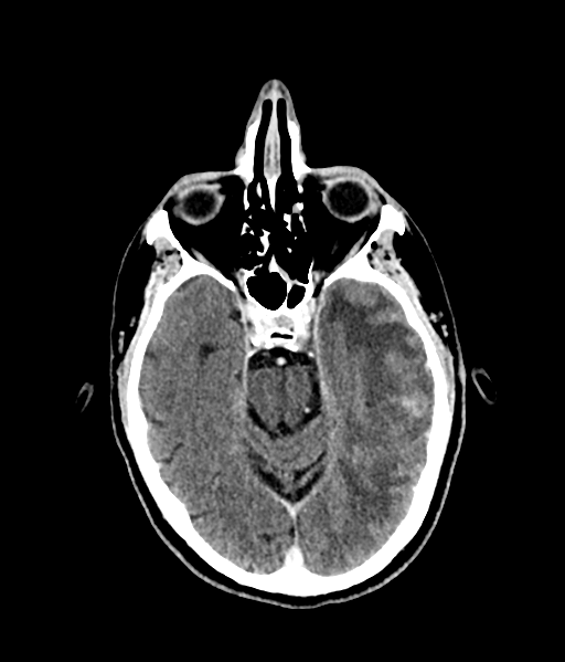 File:Brain metastasis (large cystic mass) (Radiopaedia 47497-52106 Axial C+ 25).png
