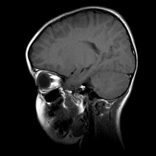 File:Brainstem ganglioglioma (Radiopaedia 10763-11224 Sagittal T1 13).jpg