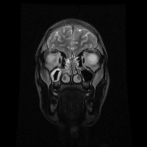 File:Brainstem glioma (Radiopaedia 30923-31624 Coronal T2 18).jpg