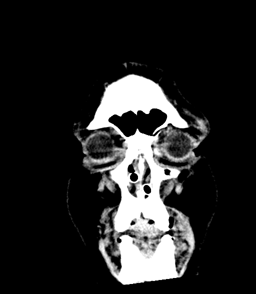 Brainstem hemorrhage (Radiopaedia 81294-94976 Coronal non-contrast 5).jpg