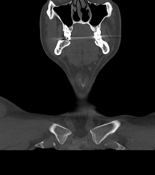 Branchial cleft cyst (Radiopaedia 31167-31875 Coronal bone window 20).jpg