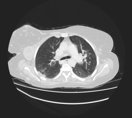 Breast metastases from facial malignant melanoma (Radiopaedia 60316-67975 Axial lung window 39).jpg