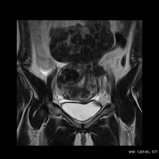File:Broad ligament fibroid (Radiopaedia 49135-54241 Coronal T2 9).jpg