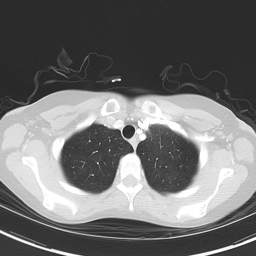 Bronchial atresia (Radiopaedia 73677-84470 Axial lung window 12).jpg
