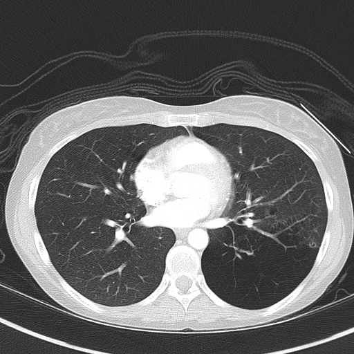Bronchial atresia (Radiopaedia 73677-84470 Axial lung window 36).jpg