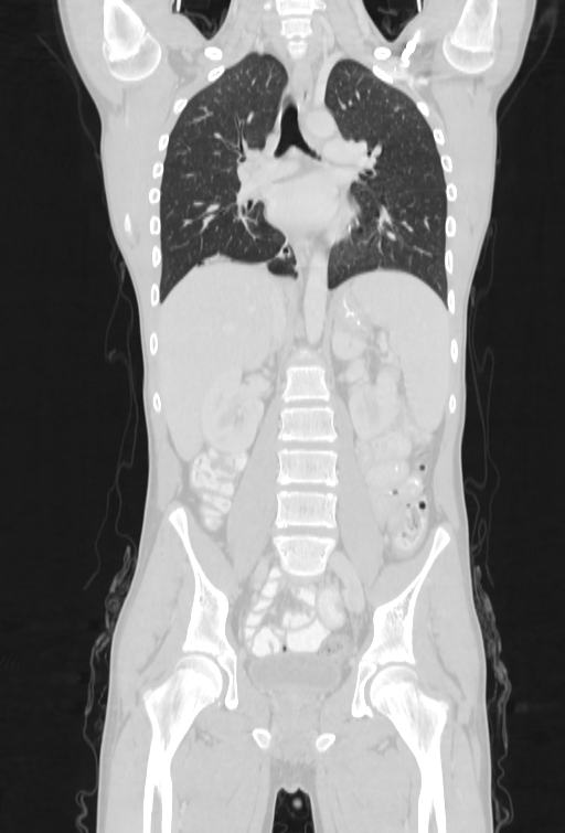 Bronchial carcinoid tumor (Radiopaedia 57187-64090 Coronal lung window 52).jpg