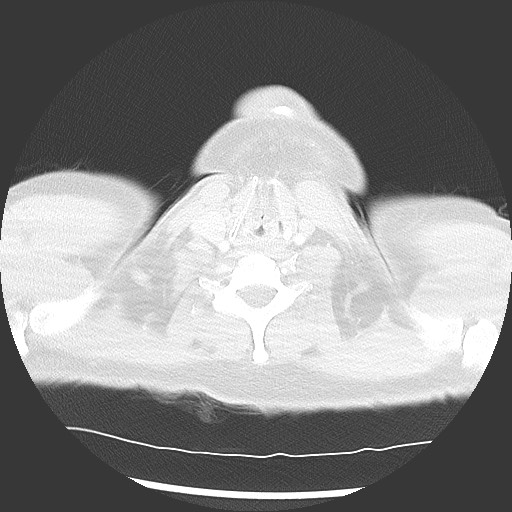 Bronchial carcinoid tumor (Radiopaedia 67377-76764 Axial lung window 2).jpg