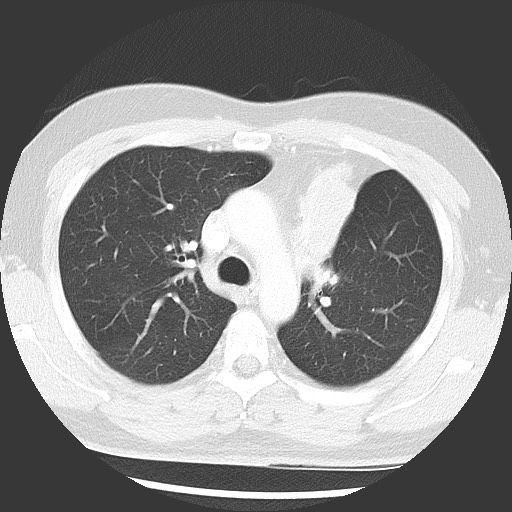 Bronchial carcinoid tumor (Radiopaedia 67377-76764 Axial lung window 24).jpg