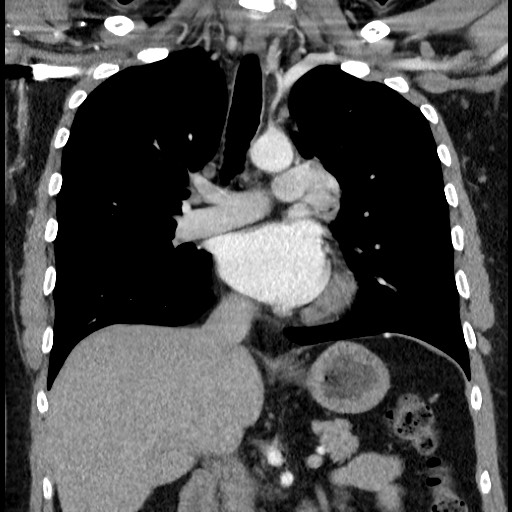 Bronchial carcinoid tumor (Radiopaedia 67377-76764 C 36).jpg