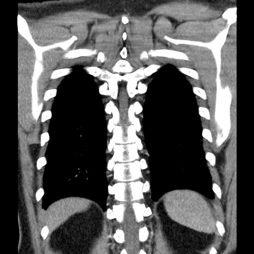 File:Bronchial carcinoid tumor (Radiopaedia 67377-76764 C 52).jpg