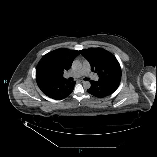 Bronchial carcinoid tumor (Radiopaedia 78272-90870 Axial non-contrast 45).jpg