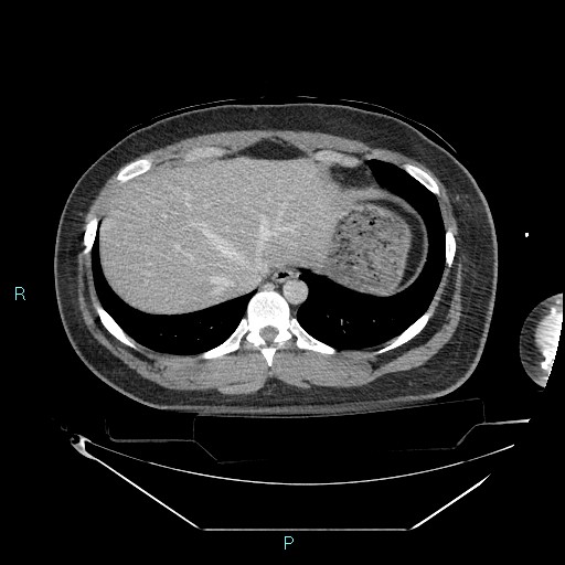 Bronchial carcinoid tumor (Radiopaedia 78272-90870 C 101).jpg