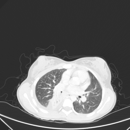Bronchial mucoepidermoid carcinoma (Radiopaedia 57023-63895 Axial lung window 54).jpg