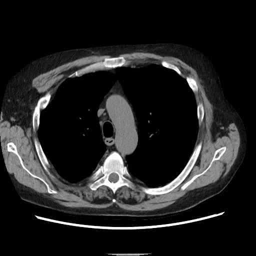 File:Bronchial stenosis - lung transplant (Radiopaedia 73133-83848 Axial non-contrast 21).jpg