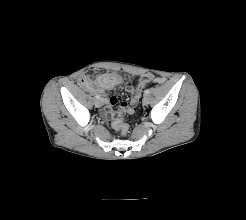 File:Bronchiectasis in Crohn disease (Radiopaedia 60311-67977 B 150).jpg
