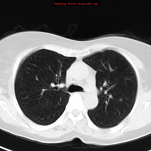 File:Bronchoalveolar carcinoma (BAC) (Radiopaedia 13436-13392 Axial lung window 19).jpg